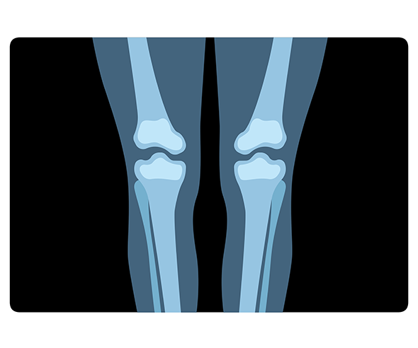 다리 엑스레이 사진