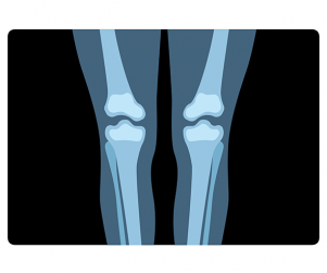 다리 엑스레이 사진