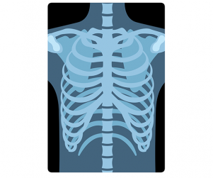 갈비뼈 엑스레이 사진