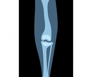 동물 다리 엑스레이 사진